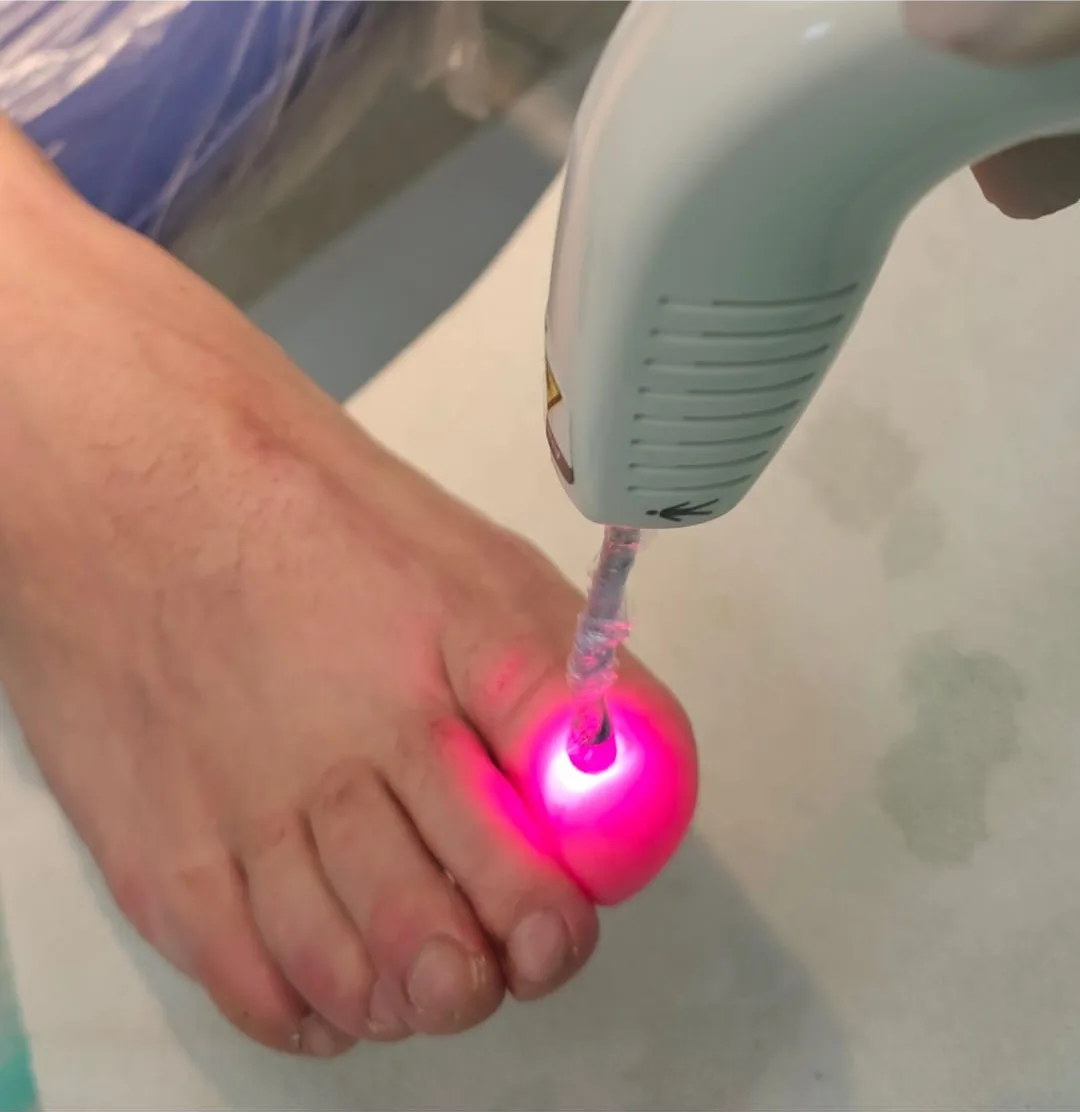 Tratamento a Laser por Sessão