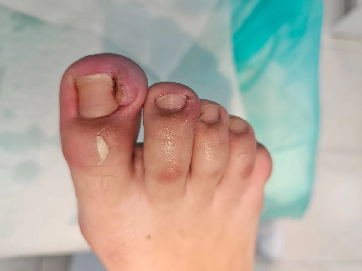 Tratamento de Unhas Encravadas (Onicocriptose)