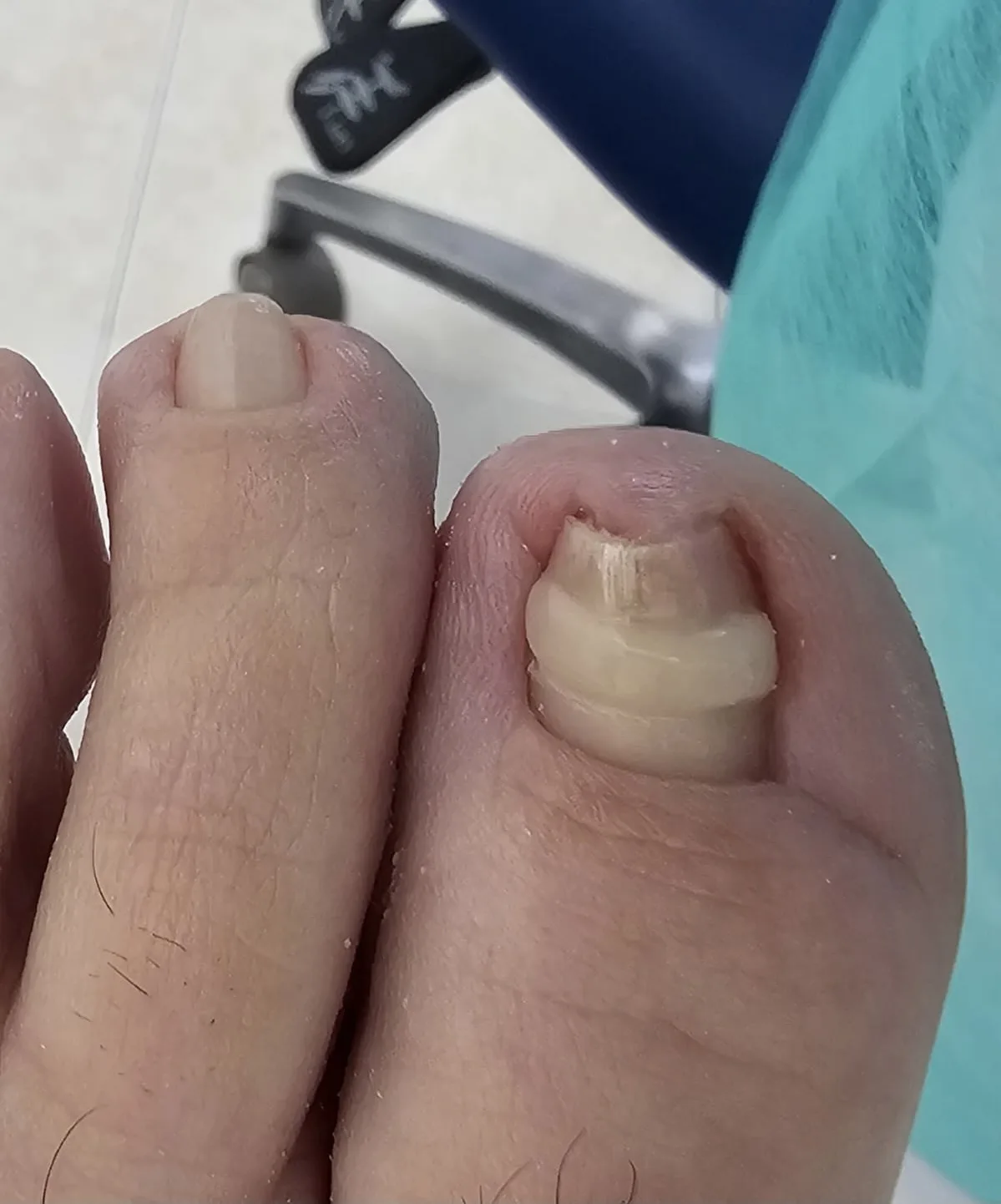Tratamento de Unhas Grossas (Onicogrifose)
